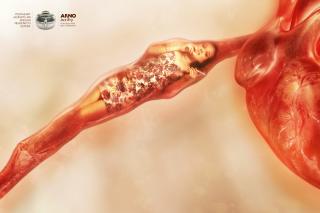 Arno: Clogged Arteries - Pregnant Daughter